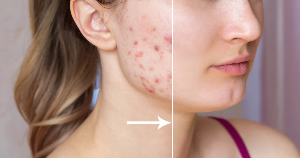 Acne Treatment Results With Improved Skin Texture And Clarity in Niceville, FL | Blissful Beauty Bar